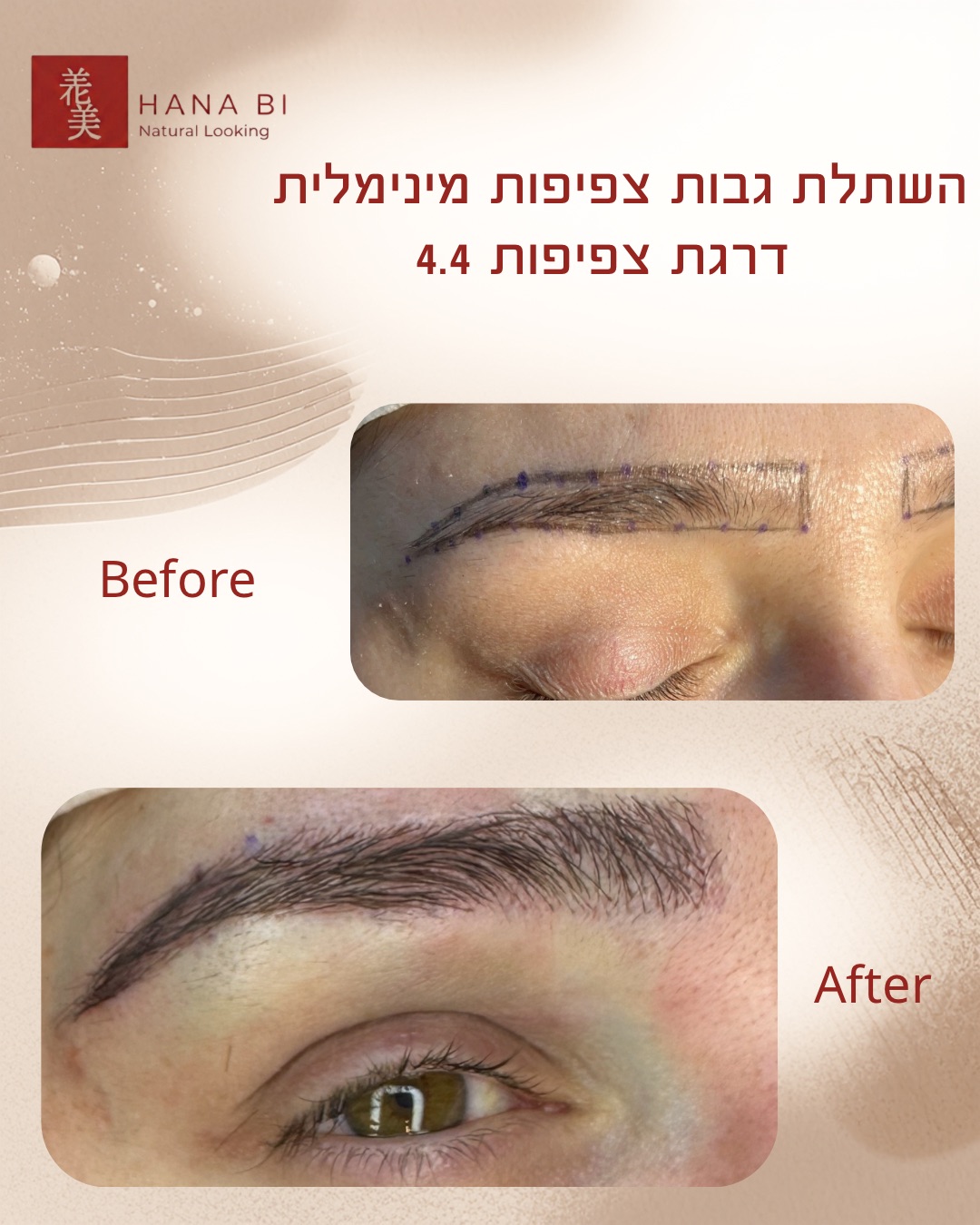 תוצאת השתלת גבות