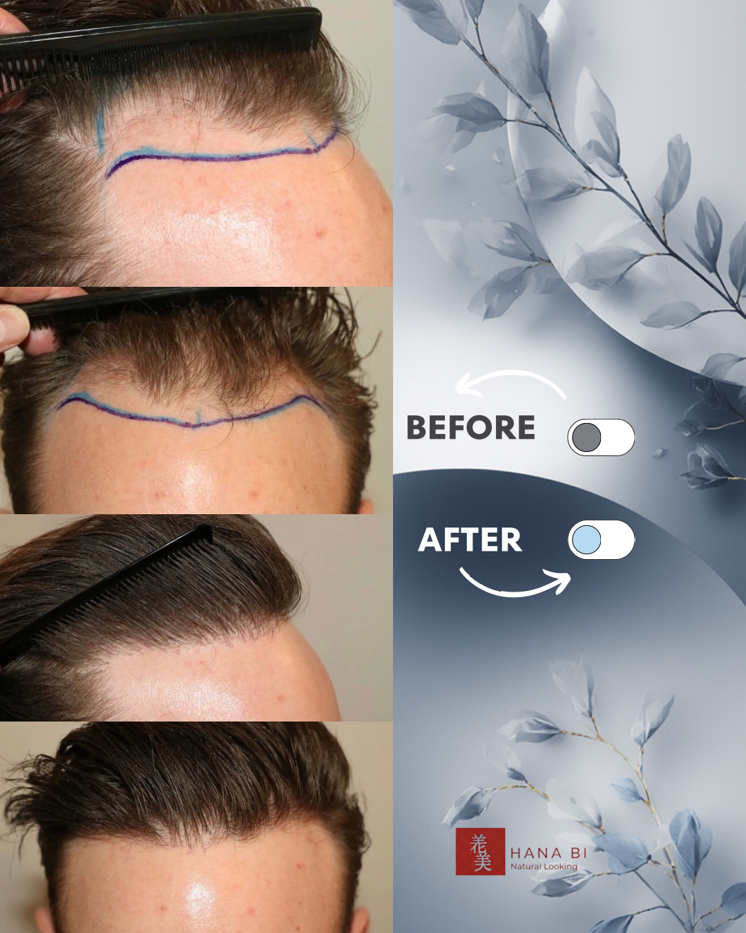 תוצאת השתלת שיער - לפני ואחרי 3