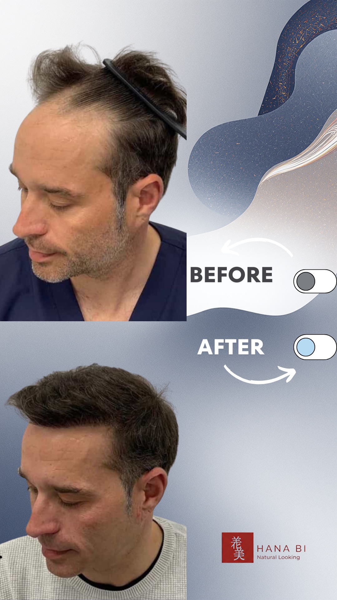 תוצאת השתלת שיער - לפני ואחרי 5