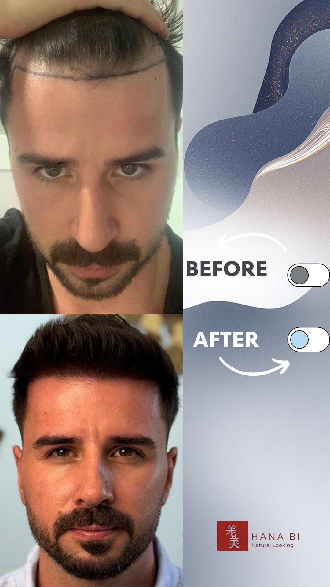 תוצאת השתלת שיער - לפני ואחרי 1